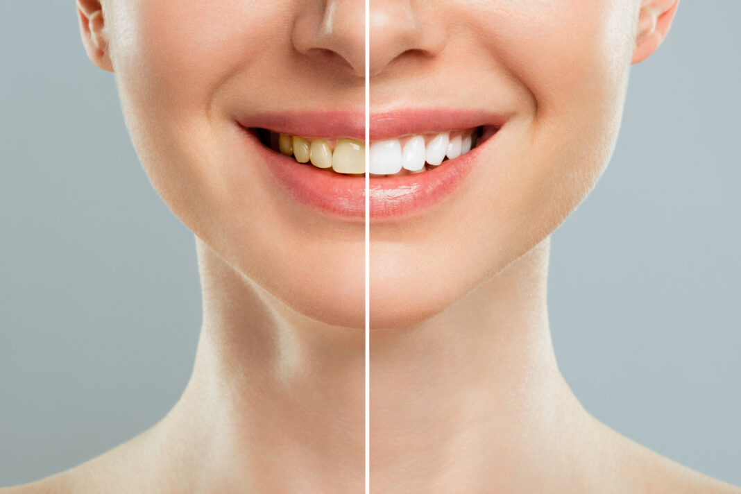 woman teeth before and after whitening. Over white background. Dental clinic patient. Image symbolizes oral care dentistry, stomatology