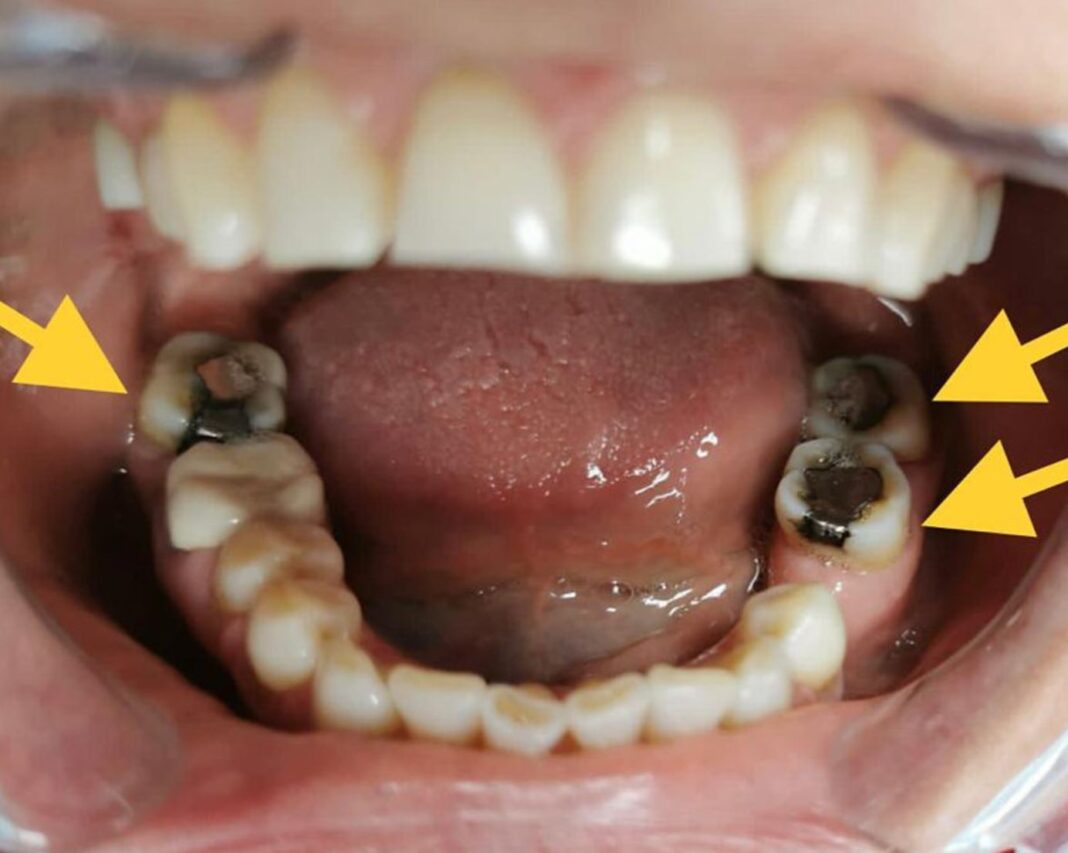 Atenție la ce ai în gura! Plombele cu metale grele te pot îmbolnăvi